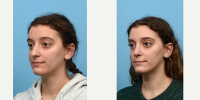 18-24 year old woman treated with Septoplasty - Looking to correct some breathing problems along with improving her nose shape, this 23-year-old patient turned to Dr. Wise for rhino-and septoplasty. Six weeks after the surgery, the patient loves her new nose and ability to breathe easy.