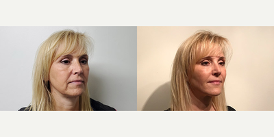 45-54 year old woman treated with Kybella, Dermal Fillers - 45-54 year old woman treated with Kybella, Dermal Fillers