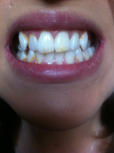 what-are-these-yellow-orange-spots-on-my-teeth-photo-doctor-answers