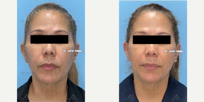 55-64 year old woman treated with Facial Fat Transfer, Morpheus8 - 55-64 year old woman treated with Facial Fat Transfer, Morpheus8