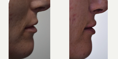 35-44 year old woman treated with Lip Augmentation - Natural appearing lip enhancement using Juvederm in New Orleans