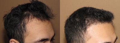 FUE Nograft hair transplantation - Neograft FUE hair transplantation