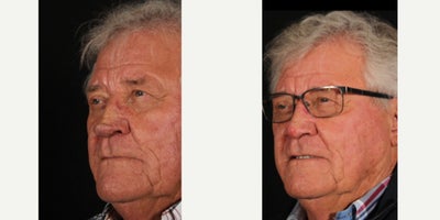 75 and up year old man treated with Laser Resurfacing - Our patient featured here underwent a rhinophyma resurfacing 25 years ago and decided this year it was time for some fine tuning. We used a scalpel and an Erbium laser to resurface his nose for better contouring (and breathing). He is 6 weeks out from the procedure and was nice enough to allow us to share there photos. We expect it to continue to settle over the next few months to a year.