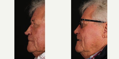 75 and up year old man treated with Laser Resurfacing - Our patient featured here underwent a rhinophyma resurfacing 25 years ago and decided this year it was time for some fine tuning. We used a scalpel and an Erbium laser to resurface his nose for better contouring (and breathing). He is 6 weeks out from the procedure and was nice enough to allow us to share there photos. We expect it to continue to settle over the next few months to a year.