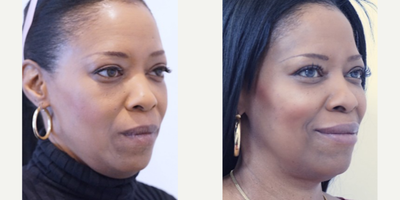 45-54 year old woman treated with Voluma - Voluma injected deep onto the malar region augments her cheek bone. Cheek filler using Voluma is a gold standard approach to rejuvenate volume loss non-surgically.