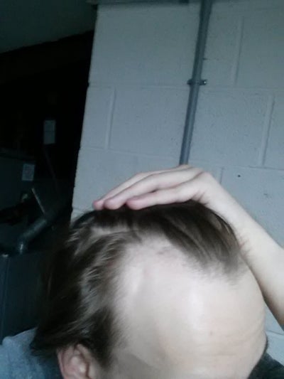 Best option for hair loss