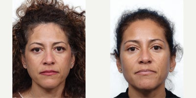 47 year old woman treated with Eyelid Surgery - At 47, this patient was concerned about signs of aging around her eyes, including excess skin and fat that created a tired appearance. She underwent an upper blepharoplasty to rejuvenate her eyelids and restore a more refreshed, youthful look. At her 2-month follow-up, her results show smoother, lifted upper lids and brighter, more open eyes with a natural appearance.
