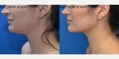 35 year old woman before and after advanced liposculpting of the chin, neck, and jawline. - This is a lovely female who wished for a more defined jawline, no double chin, and a snatched neck. We performed a specialized liposculpting procedure PRECISION SCULPT. This advanced surgery is performed under complete local anesthesia with the option of comfortable relaxation using oral medications. Tiny hidden incisions are used to evenly and smoothly remove all of the excess fat throughout the front of the neck from the chin to the angles of the jaw and down to the front of the lower neck. Laser and radiofrequency are delivered to the tissue to promote tightening. This procedure takes about 45 minutes. Patients typically return to work in a few days.