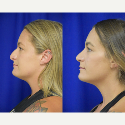 2510 - 25-34 year old woman treated with Rhinoplasty