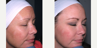 35-44 year old woman treated with Microneedling - 40 year old patient concerned with sun damage and the texture of her skin. A series of 4 micro needling treatments with Growth Factors was performed to address her concerns.