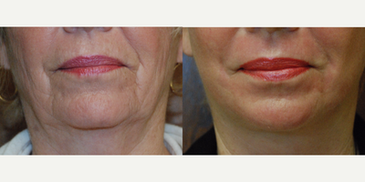 55-64 year old woman treated with Laser Resurfacing with J-Plasma - J-Plasma Resurfacing