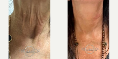 Woman treated with Skin Rejuvenation, Thread Lift, PRF Treatment - Incredible results of our non-surgical neck rejuvenation using PDO threads, PRF, and bio-stimulating agents. Natural, effective, and no downtime