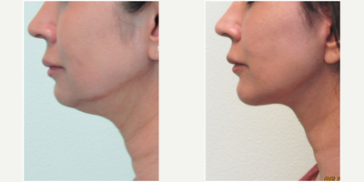 48 year old woman treated with Lower Facelift and Chin Augmentation (silicone implant) - This woman of mixed European and Asian descent presented with the concerns of reduction in her profile as well as jowling. She stated that she noticed this while taking selfies over the past few months. She wished to address these two areas after having failed treatments with ultherapy and another unknown laser.Together we decided that the best treatment for her concerns would be to tighten both the muscle and skin of her neck and jawline along with sculpting the fat under her chin. In order to create a more dramatic profile, we also decided to add a silicone chin implant to her treatment plan. Her lower facelift, necklift, and chin augmentation were performed on the same day all under local anesthesia in our Center.Her results demonstrate a much improved profile and jawline, while still maintaining a harmonious balance with her nose and cheeks.