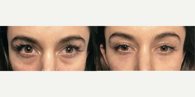 Woman treated with Belotero, Dermal Fillers, Hyaluronidase - Woman treated with Belotero, Dermal Fillers, Hyaluronidase