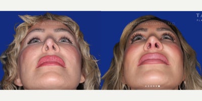 35-44 year old woman treated with Revision Rhinoplasty, Eyelid Surgery - 35-44 year old woman treated with Revision Rhinoplasty, Eyelid Surgery