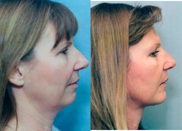Facelift - Facelift to improve neck and jawline