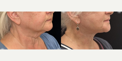 61 year old woman treated with Deep Plane Facelift, Neck Lift - 61 year old woman treated with Deep Plane Facelift, Neck Lift