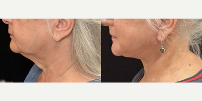 61 year old woman treated with Deep Plane Facelift, Neck Lift - 61 year old woman treated with Deep Plane Facelift, Neck Lift