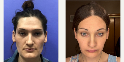 25-34 year old transgender woman treated with Facial Feminization Surgery, Transgender Facial Feminization Surgery, Brow Lift, S - 25 to 34 year-old female patient is 1 year post-op from Facial Feminization surgery. Her procedures included: Modified Coronal Forehead Lift, Orbital Bony Contour, Chin Reduction and Contour, and Septorhinoplasty (closed) with Cartilage Grafts and Weirs.