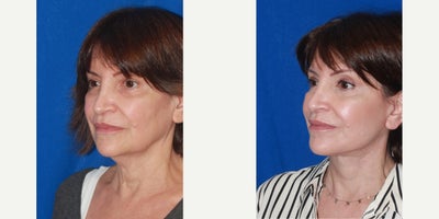 64 year old woman treated with Deep Plane Facelift, Neck Lift - 64 year old female patient after deep plane face and neck lift