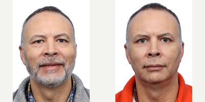 57 year old man treated with Eyelid Surgery - This 57-year-old male was concerned with aging eyes and excess skin under the eyes. He underwent an upper and lower blepharoplasty, achieving a smoother, refreshed, and more youthful eye area.