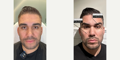 Man treated with Thread Lift - Man treated with Thread Lift