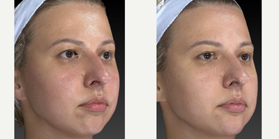 25-34 year old woman treated with Restylane Lyft - This young pretty girl came in for some chin and jawline sculpting. Dr. Caughlin is becoming known for these procedures. Pay attention to the angle of the jaw and chin projection.