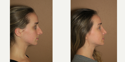 25-34 year old woman treated with Rhinoplasty - rhinoplasty