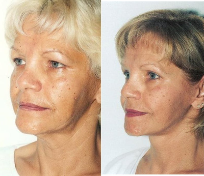 Woman treated with Facelift - Woman treated with Facelift