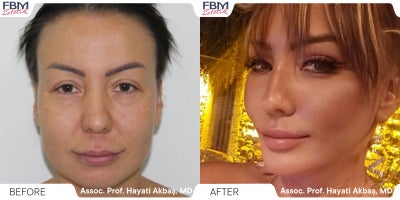 35-44 year old woman treated with Deep Plane Facelift, Facial Fat Transfer, Facelift, Lip Lift - 35-44 year old woman treated with Deep Plane Facelift, Facial Fat Transfer, Facelift, Lip Lift
