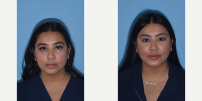 25-34 year old woman treated with Buccal Fat Removal, Chin Implant - My nurse loves the more sculpted appearance of her face. #chinimplant #neckliposuction #buccalfatremoval A rounder face is transformed in a beautifully subtle manner. The jawline looks chiseled with a slightly extended chin. Her cheek appears elevated and highlighted from the removal of #buccalfat. All in a natural way.