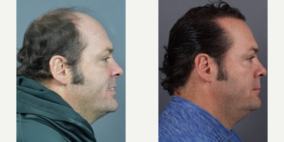 Man treated with Hair Transplant - Transplant Transformation.