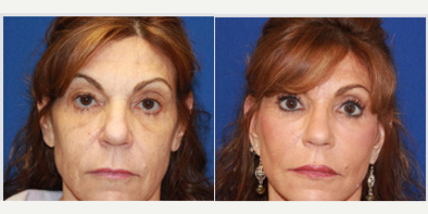 61 year old woman treated with Eyelid Surgery - 61 year old female who was c/o looking more tired than she felt. She was not happy with the sagging skin on the upper eyelids, and her neck banding that made her look older than she felt. At the consultation, we decided on performing an upper eyelid blepharoplasty to remove the excess upper eyelid skin, a facial fat transfer to volume and lift her cheeks and soften her nasolabial and marionette lines, a face and neck lift to lift and contour her jawline and neck and CO2 laser skin resurfacing to help improve the skin tone, texture and fine lines along with age/sun spots. Here she is about 3 months post procedure looking fabulous and gorgeous as ever. She feels wonderful with her refreshed look. Her procedure was performed without general anesthesia.