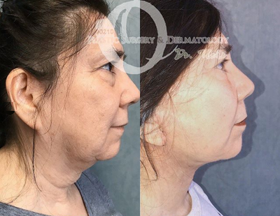 Woman treated with Neck Lift - Woman treated with Neck Lift