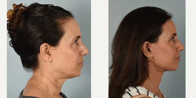 55-64 year old woman treated with Facelift, Neck Lift, Fractional Laser - This patient had the following procedures: mini facelift, neck lift, and fractional CO2 laser. After photos are 3 months post op.