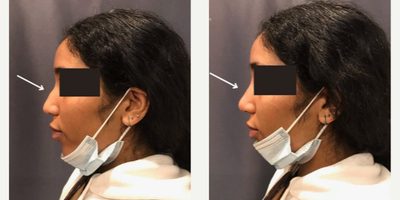 Woman treated with Nonsurgical Nose Job - Non-surgical Rhinoplasty
