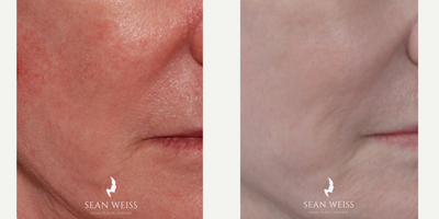 55-64 year old woman treated with CO2 Laser - CO2 Laser can help improve texture and to eliminate damage from years in the sun.