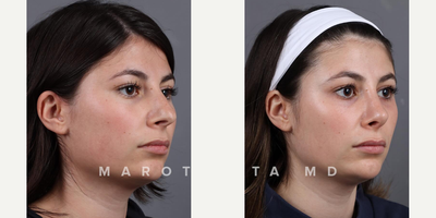 Woman treated with Septoplasty - Great results from our patients journey. Transformation through Rhinoplasty/Septoplasty by Dr James Marotta