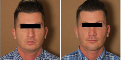 Man treated with Chin Implant - Man treated with Chin Implant and Rhinoplasty