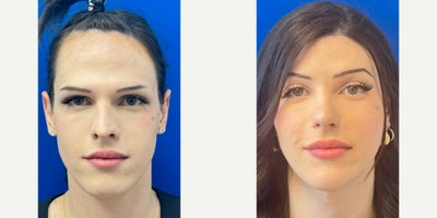 25-34 year old transgender woman treated with Facial Feminization Surgery - Facial Feminization