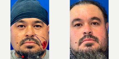 35-44 year old man treated with Facial Reconstructive Surgery - Facial Reconstrcution Following Moh's Procedure