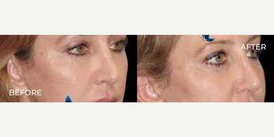 Woman treated with Rhinoplasty - Woman treated with Rhinoplasty