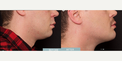 Man treated with Chin Implant - Man treated with Chin Implant