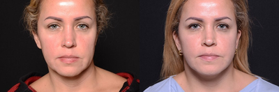 30-39 year old woman treated with Facelift - 30-39 year old woman treated with Facelift