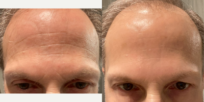 55-64 year old man treated with Daxxify - 2 weeks after Daxxify for forehead wrinkles