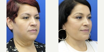 35-44 year old woman treated with Neck Lift, Lower Facelift - This lady desires full neck rejuvenation. She undergoes necklift and lower facelift in a deep plane manner. Her neck result is simply fantastic so decision is made to categorize this result under necklift.