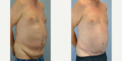 55-64 year old man treated with Male Tummy Tuck - Male tummy tuck