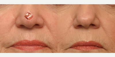 Woman treated with Facial Reconstructive Surgery - Woman treated with Facial Reconstructive Surgery