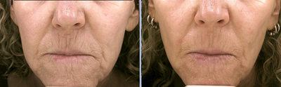Pro-Fractional Laser -
Pro-Fractional Laser