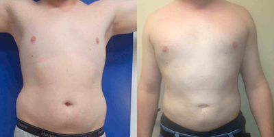 35-44 year old woman treated with Tumescent Liposuction - Male lipo contouring awake
